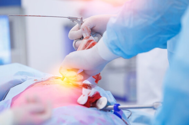 Intestinal Surgery------12